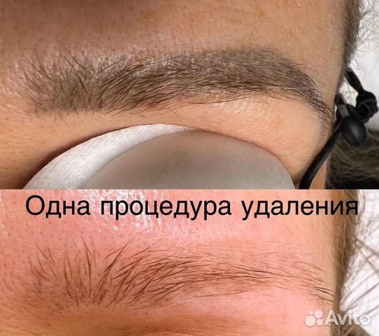 Лазерное удаление тату за одну процедуру*