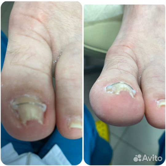 Педикюр пожилым на дому