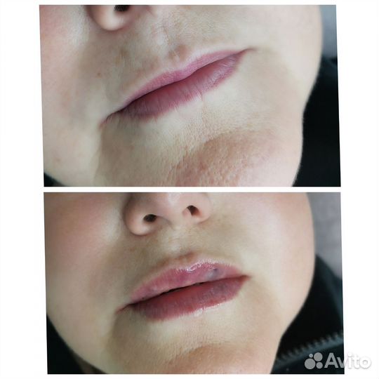 Контурная пластика губ