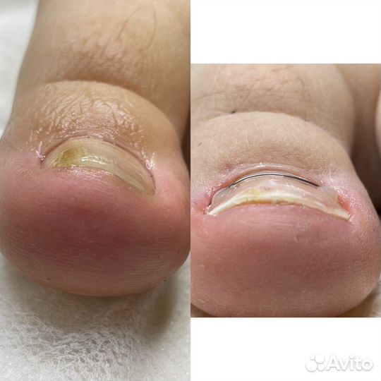 Педикюр подолог