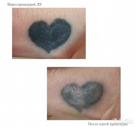 Удаление татуировок и татуажа