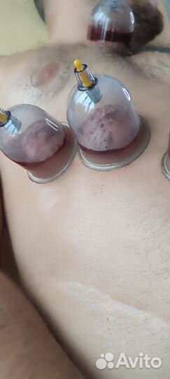 Хиджама (обучение) / капиляротерапия лица